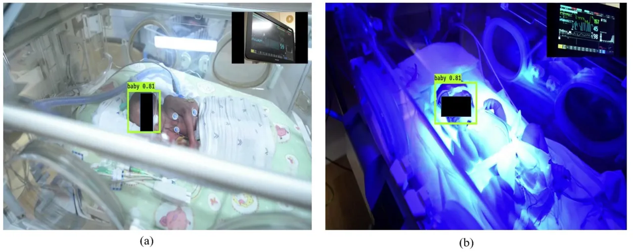 南澳大学研究人员开发人工智能面部识别技术来监测早产儿